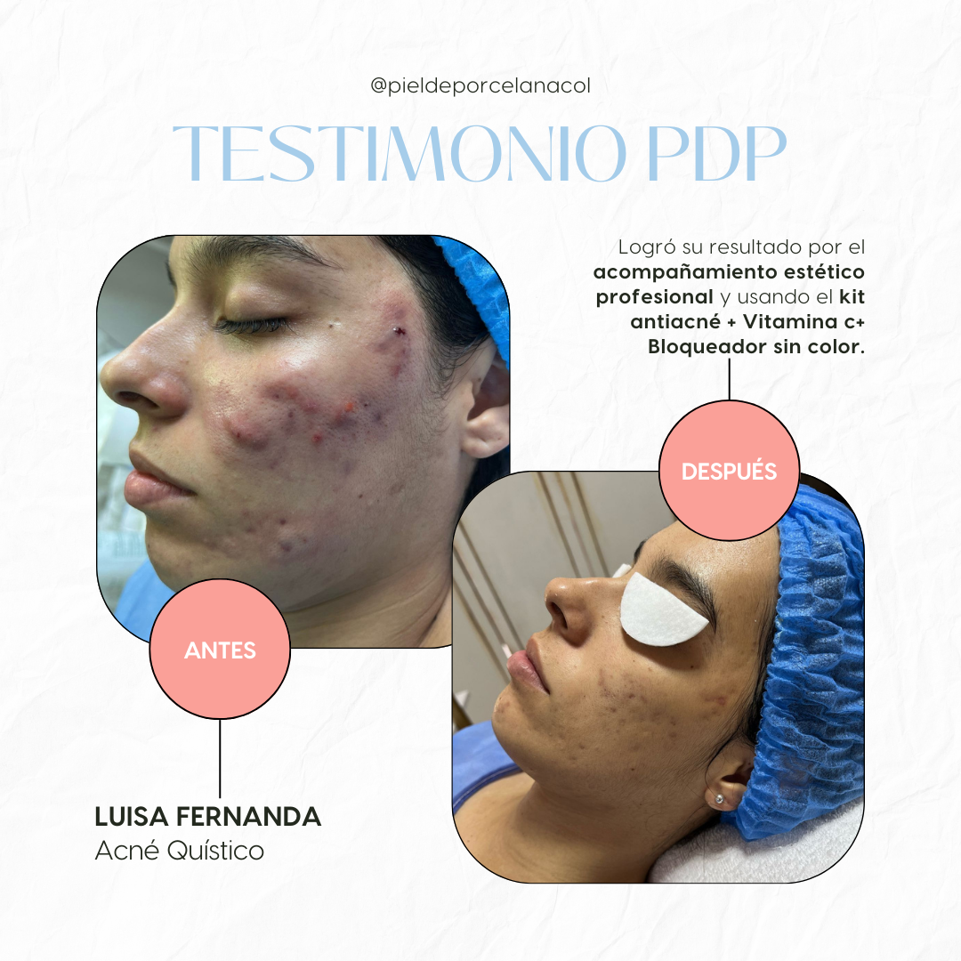 Kit Anti Acne