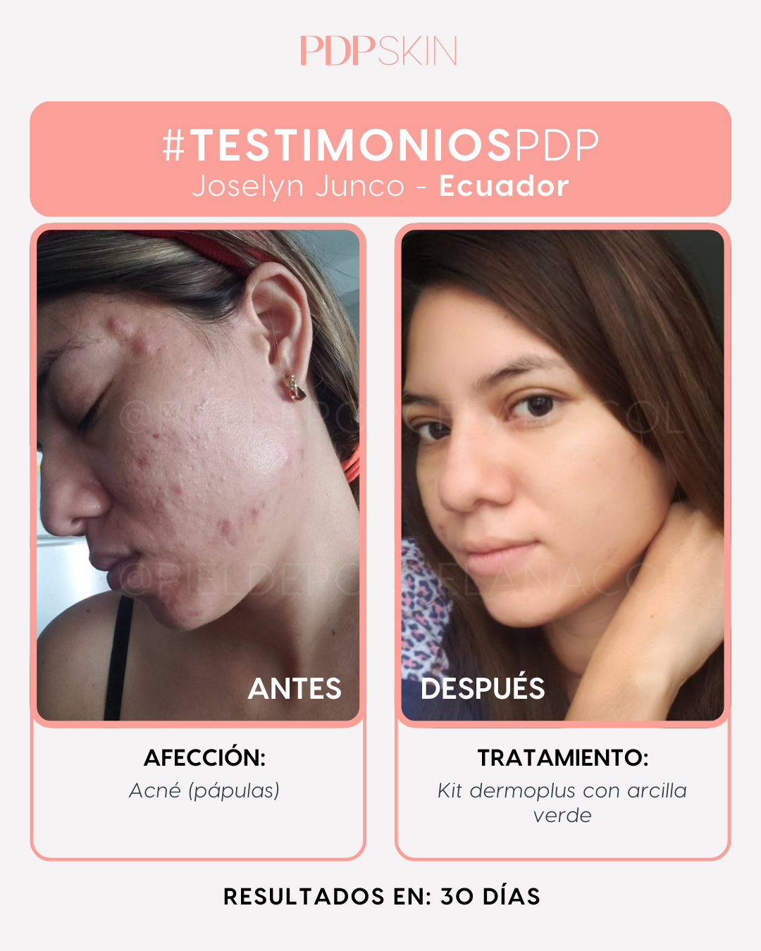 Kit Anti Acne