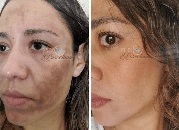 Tonico Anti Manchas Faciales y Corporales